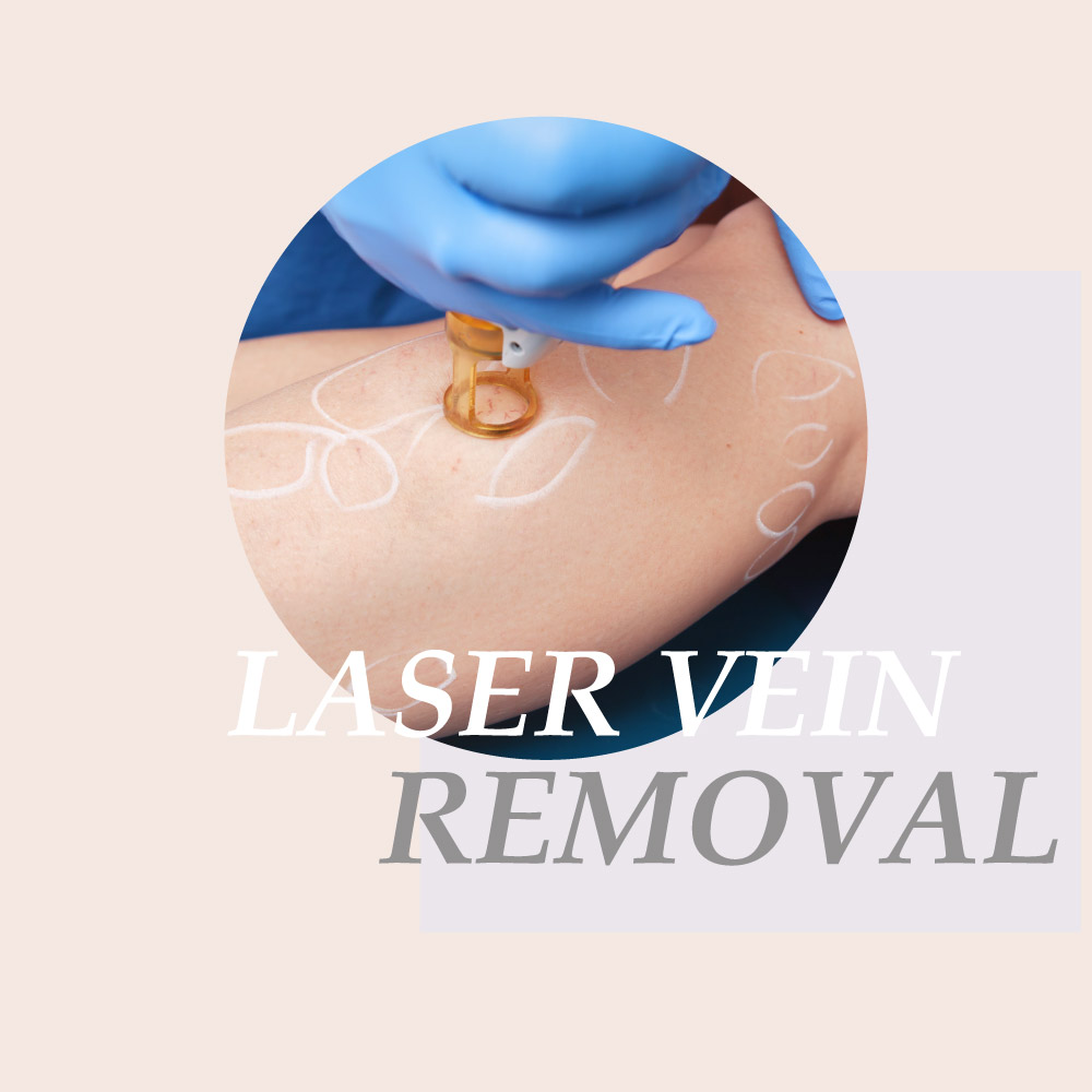 laser vein removal